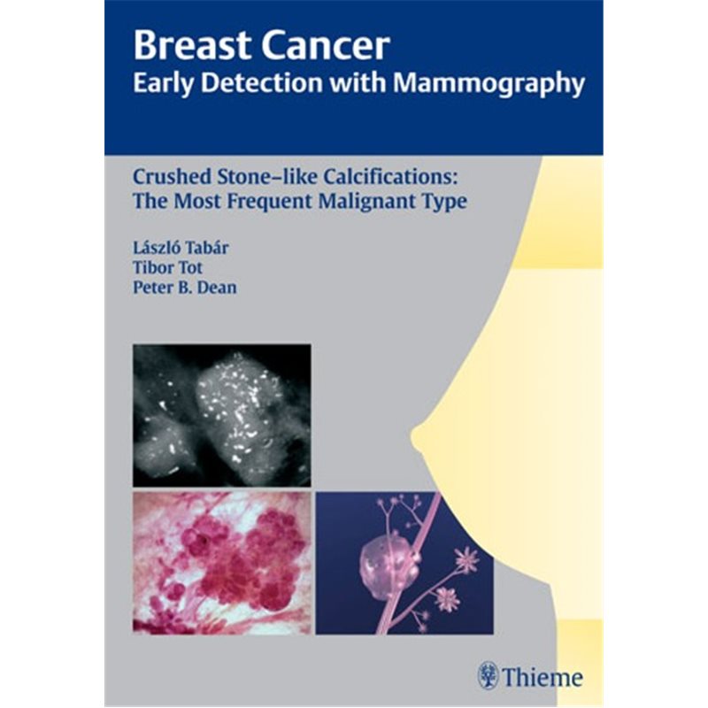Breast Cancer: Early Detection with Mammography - Crushed Stone-like Calcifications: The Most Frequent Malignant Type